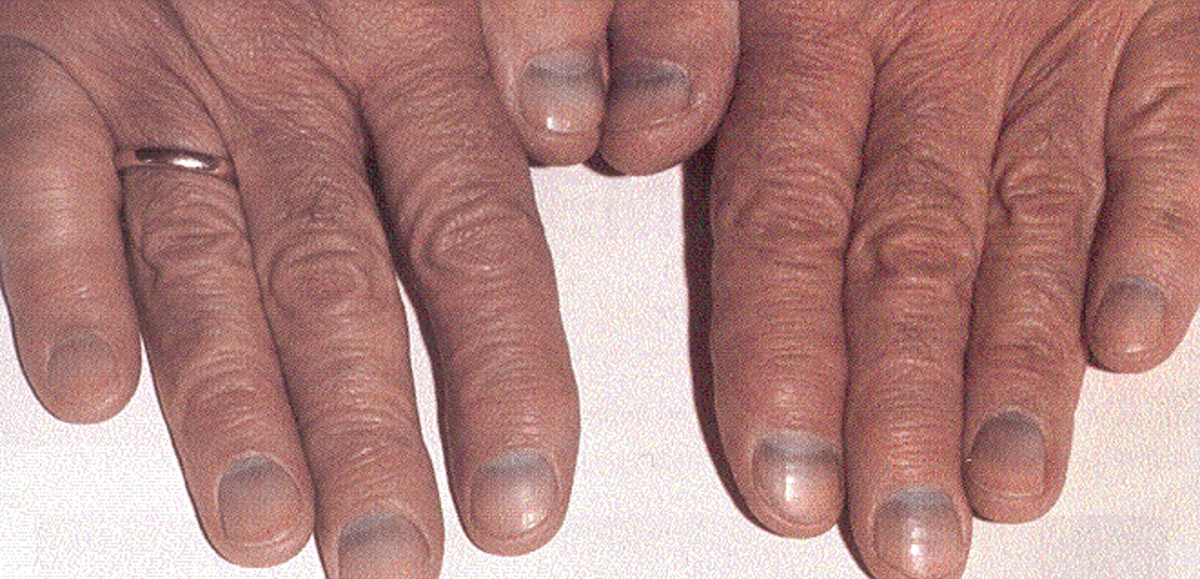Yellow Nail Syndrome: Yellow Nails, Lymphedema, Bronchiectasis, Pleural  Effusions and Sinusitis... - Academic Dermatology of Nevada