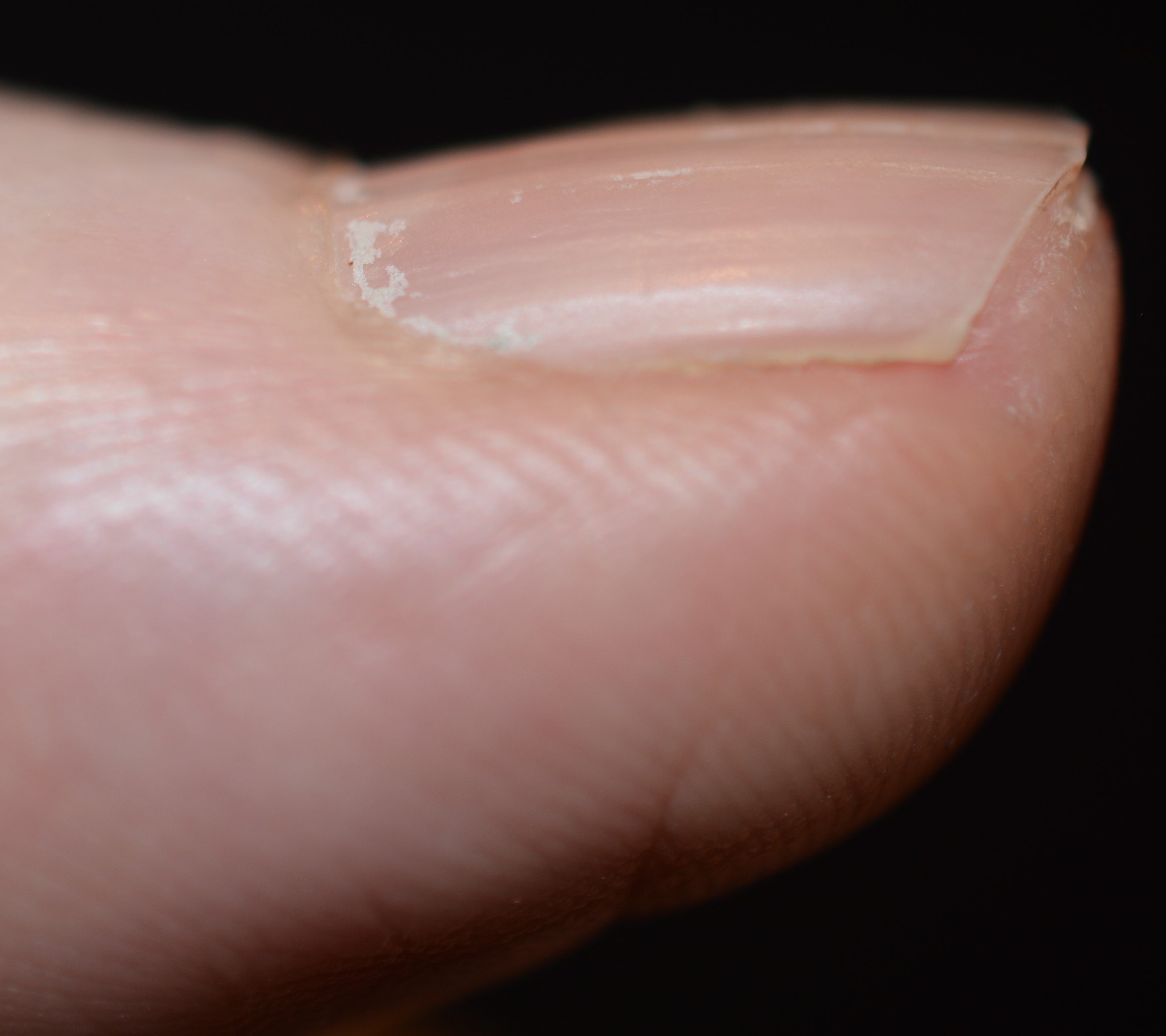 My nail lichen planus began improving within 4 months of the treatment...