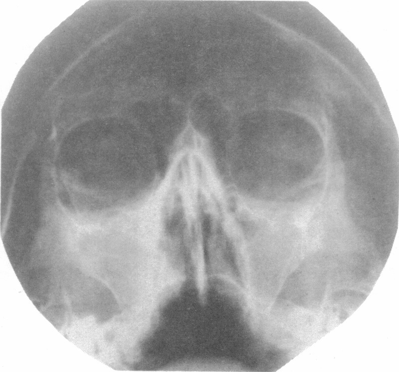 sinus x-rays