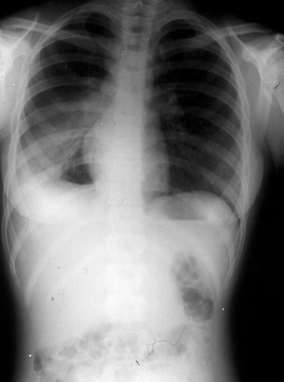 chest & abdomen x-ray