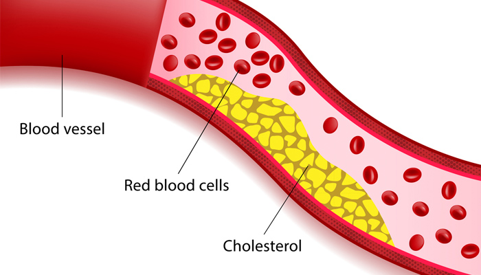 Photo for High Cholesterol (Hyperlipidemia)